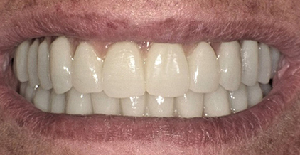 centro implantologia dentale lanciano dopo